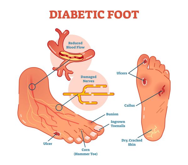 diabetik ayaq